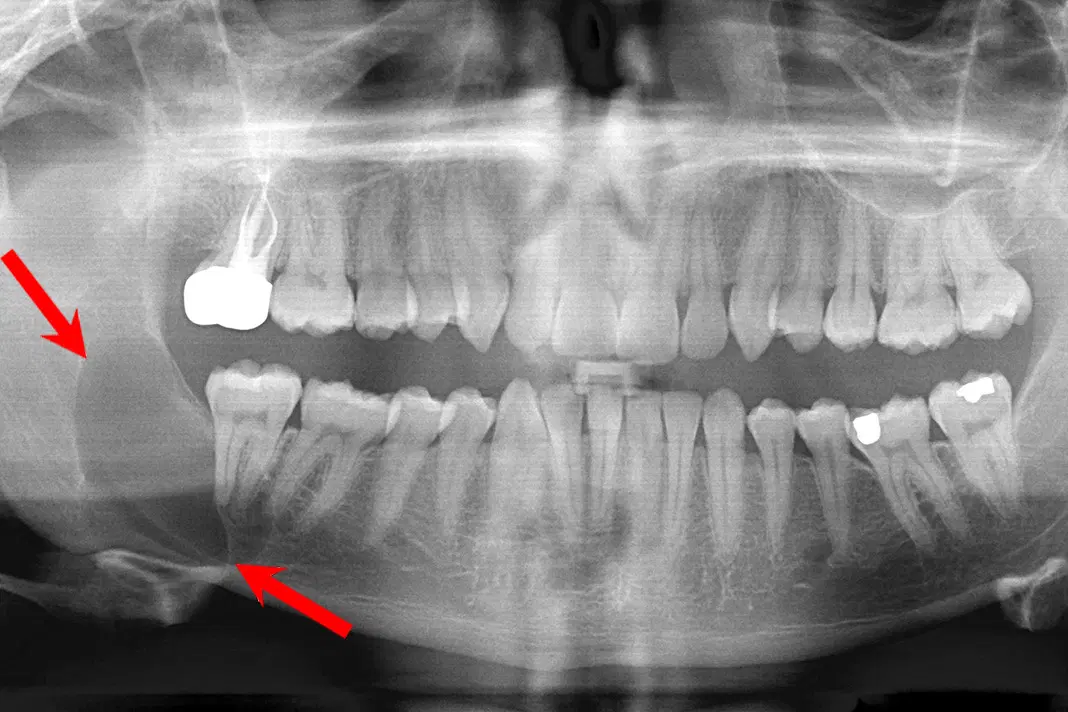 Panoramic dental X-ray showing advanced tooth decay and an abscessed tooth